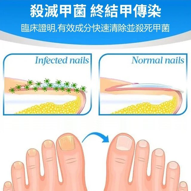 指甲抑菌膏